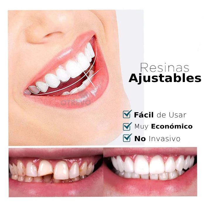 SmileFit® - Carillas Dentales Naturales Removibles