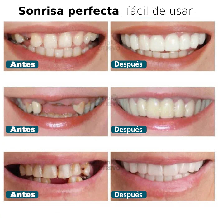 SmileFit® - Carillas Dentales Naturales Removibles